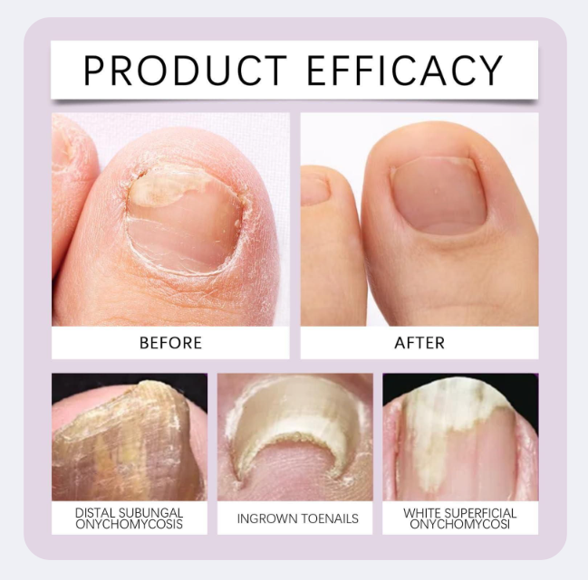 BeeVenom Natural Nail Fungus Remedy (Pack of 2)